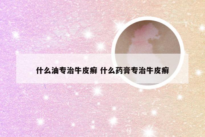 什么油专治牛皮癣 什么药膏专治牛皮癣