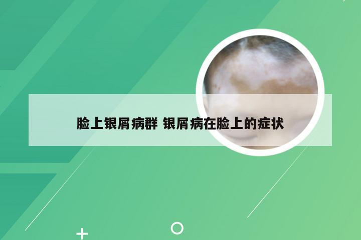 脸上银屑病群 银屑病在脸上的症状