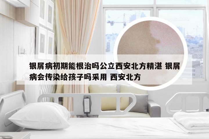 银屑病初期能根治吗公立西安北方精湛 银屑病会传染给孩子吗采用 西安北方