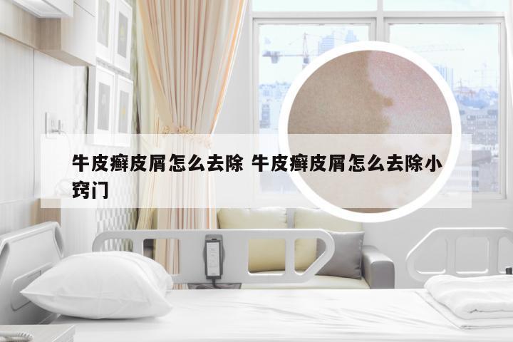 牛皮癣皮屑怎么去除 牛皮癣皮屑怎么去除小窍门