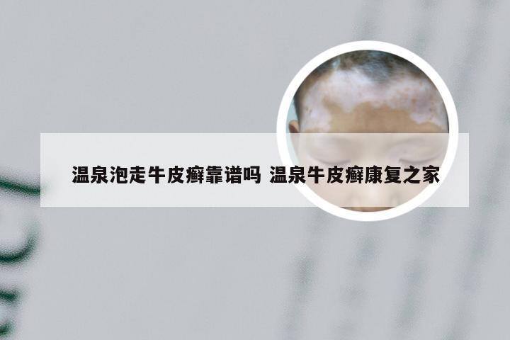 温泉泡走牛皮癣靠谱吗 温泉牛皮癣康复之家