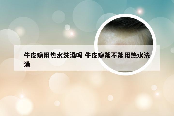 牛皮癣用热水洗澡吗 牛皮癣能不能用热水洗澡