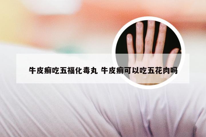 牛皮癣吃五福化毒丸 牛皮癣可以吃五花肉吗