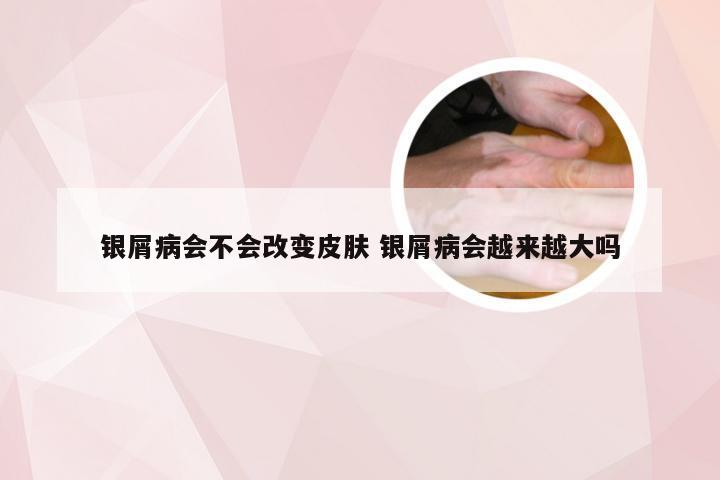 银屑病会不会改变皮肤 银屑病会越来越大吗