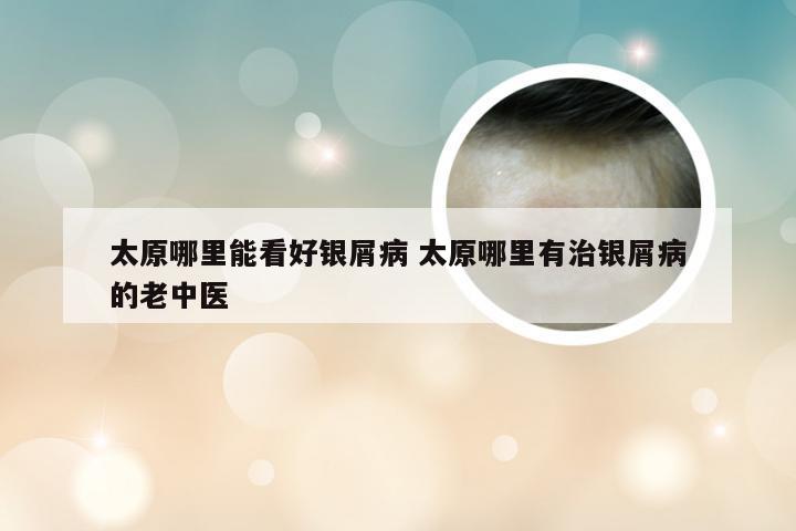 太原哪里能看好银屑病 太原哪里有治银屑病的老中医