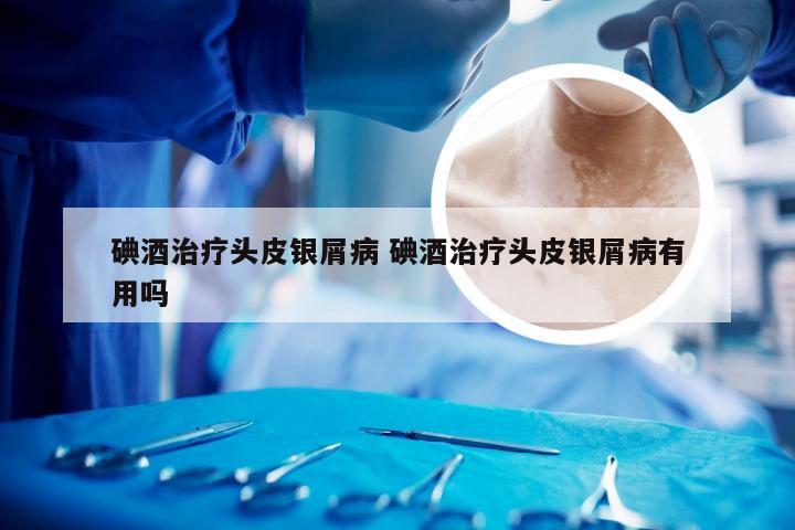碘酒治疗头皮银屑病 碘酒治疗头皮银屑病有用吗
