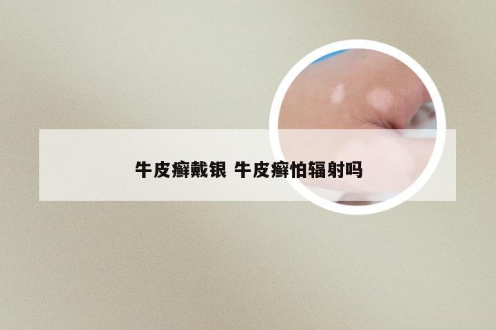 牛皮癣戴银 牛皮癣怕辐射吗
