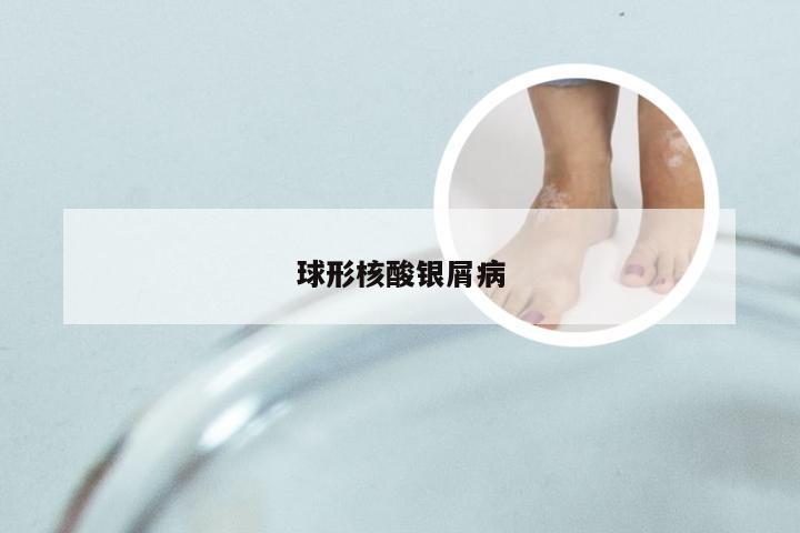 球形核酸银屑病