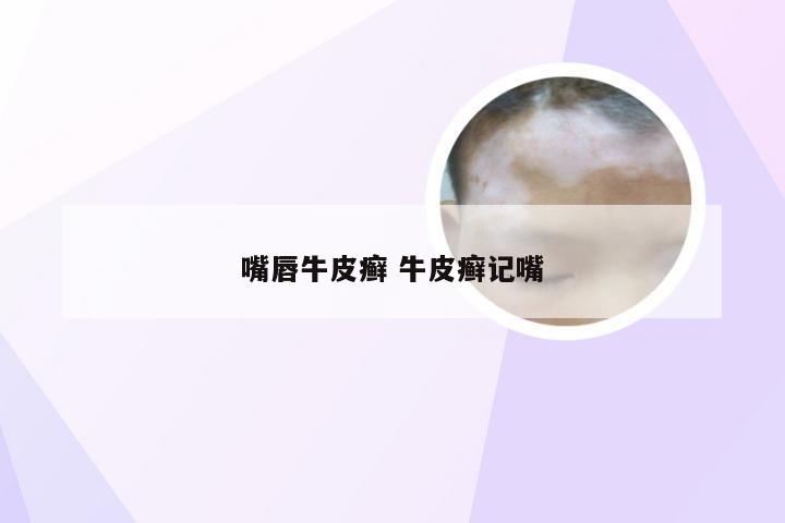 嘴唇牛皮癣 牛皮癣记嘴