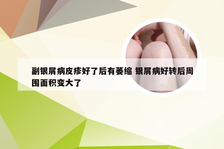 副银屑病皮疹好了后有萎缩 银屑病好转后周围面积变大了