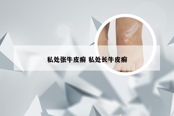 私处张牛皮癣 私处长牛皮癣
