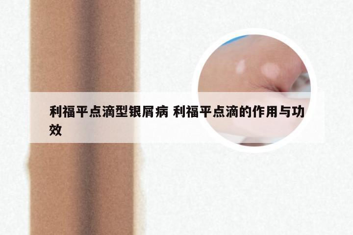 利福平点滴型银屑病 利福平点滴的作用与功效