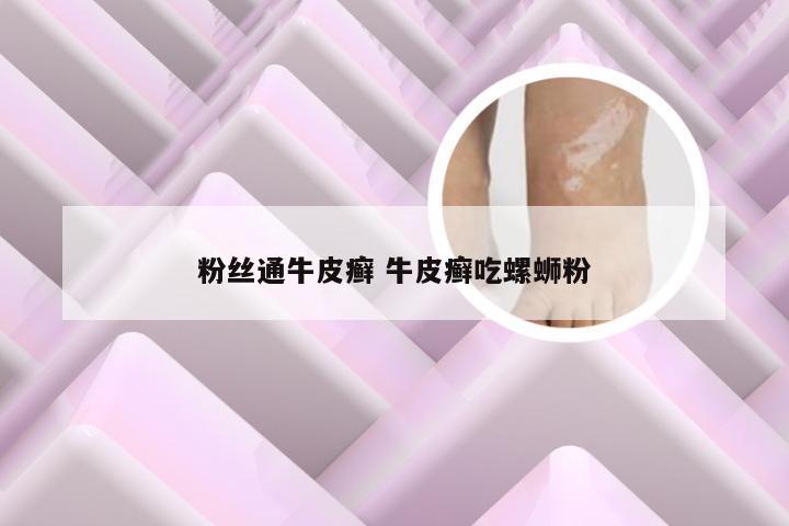 粉丝通牛皮癣 牛皮癣吃螺蛳粉