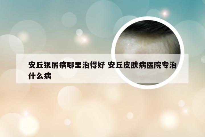 安丘银屑病哪里治得好 安丘皮肤病医院专治什么病