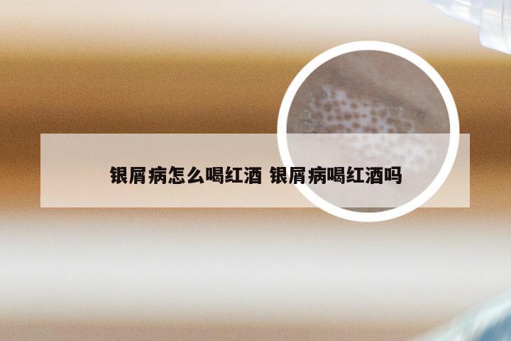银屑病怎么喝红酒 银屑病喝红酒吗