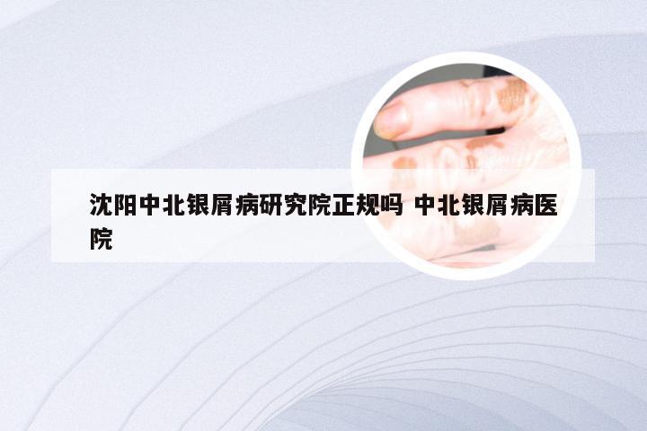 沈阳中北银屑病研究院正规吗 中北银屑病医院