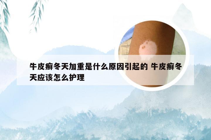 牛皮癣冬天加重是什么原因引起的 牛皮癣冬天应该怎么护理