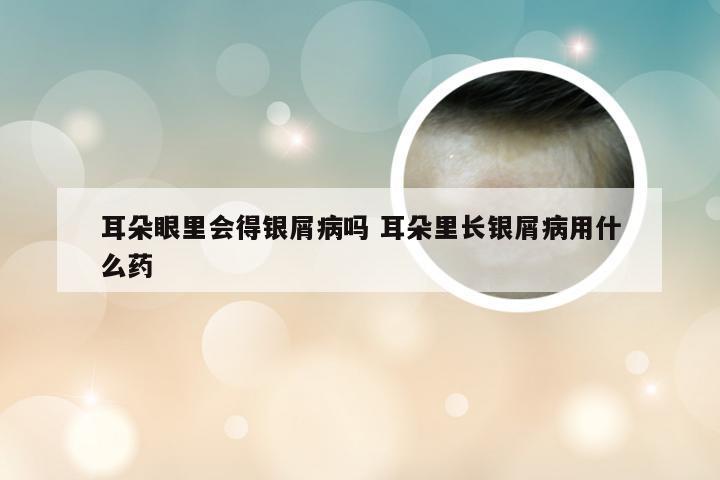 耳朵眼里会得银屑病吗 耳朵里长银屑病用什么药