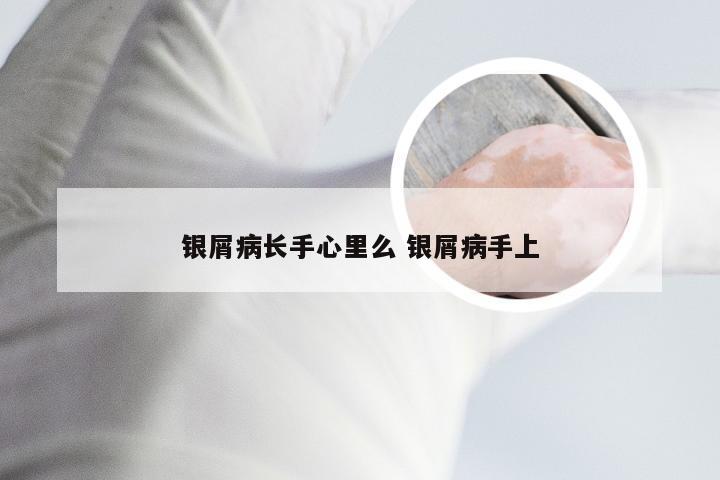 银屑病长手心里么 银屑病手上