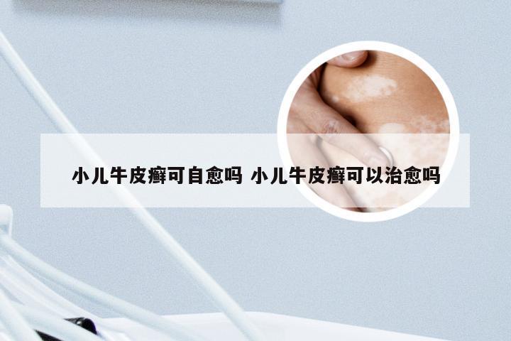 小儿牛皮癣可自愈吗 小儿牛皮癣可以治愈吗