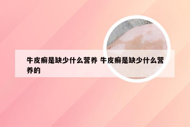 牛皮癣是缺少什么营养 牛皮癣是缺少什么营养的