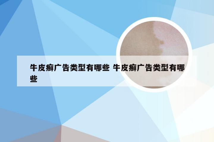 牛皮癣广告类型有哪些 牛皮癣广告类型有哪些