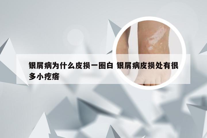 银屑病为什么皮损一圈白 银屑病皮损处有很多小疙瘩