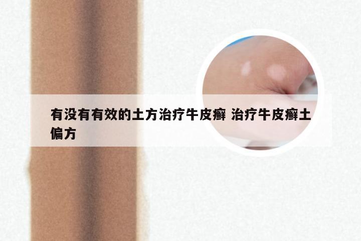 有没有有效的土方治疗牛皮癣 治疗牛皮癣土偏方