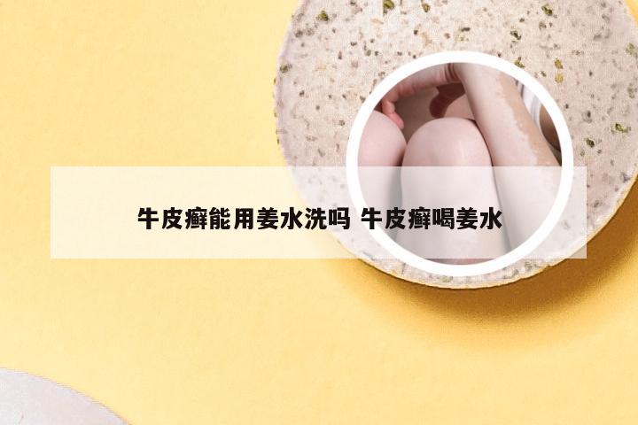 牛皮癣能用姜水洗吗 牛皮癣喝姜水