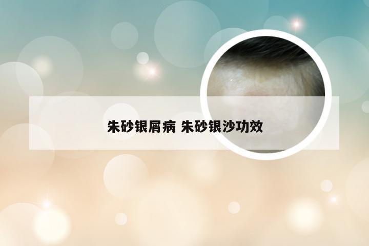 朱砂银屑病 朱砂银沙功效