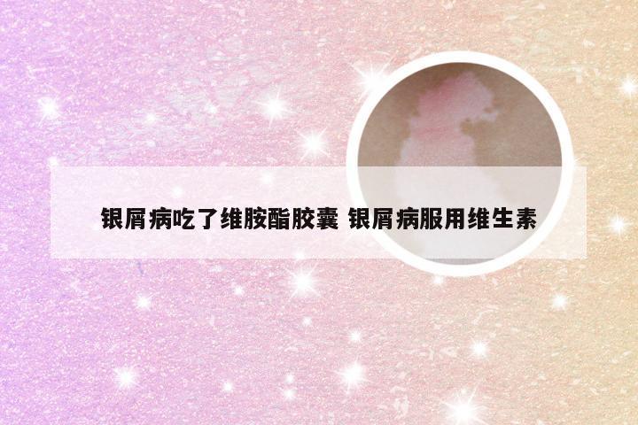 银屑病吃了维胺酯胶囊 银屑病服用维生素
