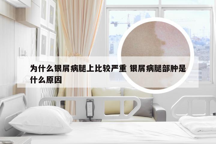 为什么银屑病腿上比较严重 银屑病腿部肿是什么原因
