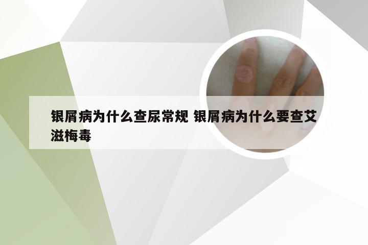 银屑病为什么查尿常规 银屑病为什么要查艾滋梅毒