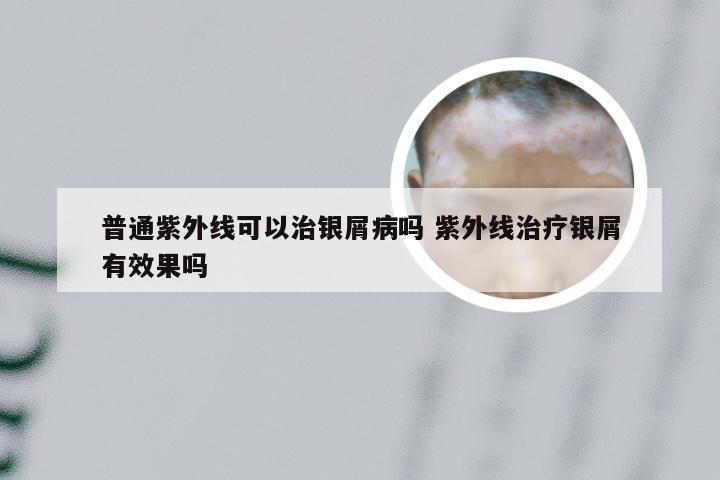 普通紫外线可以治银屑病吗 紫外线治疗银屑有效果吗