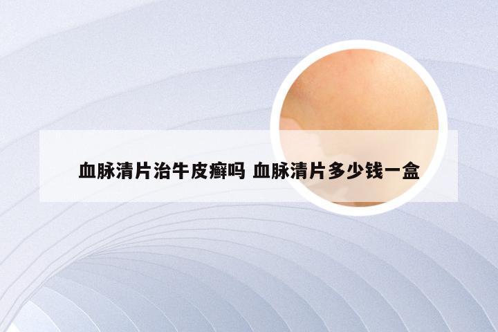 血脉清片治牛皮癣吗 血脉清片多少钱一盒
