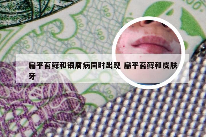 扁平苔藓和银屑病同时出现 扁平苔藓和皮肤牙