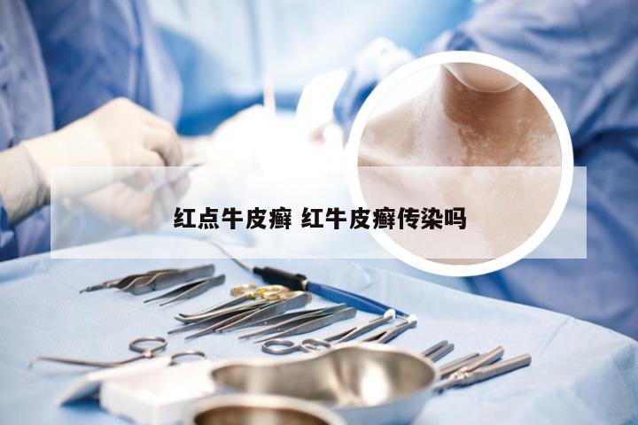 红点牛皮癣 红牛皮癣传染吗