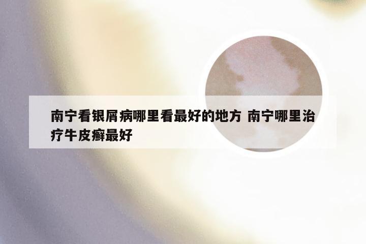 南宁看银屑病哪里看最好的地方 南宁哪里治疗牛皮癣最好