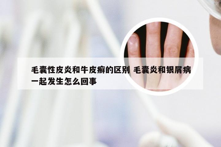 毛囊性皮炎和牛皮癣的区别 毛囊炎和银屑病一起发生怎么回事