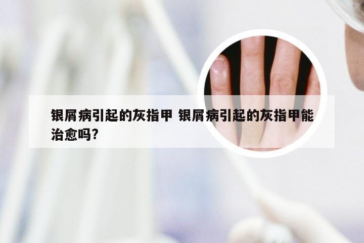 银屑病引起的灰指甲 银屑病引起的灰指甲能治愈吗?