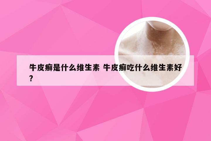 牛皮癣是什么维生素 牛皮癣吃什么维生素好?