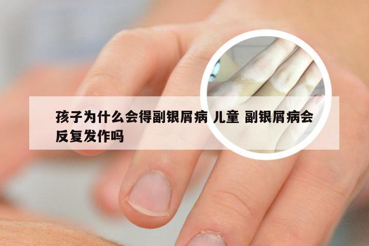 孩子为什么会得副银屑病 儿童 副银屑病会反复发作吗