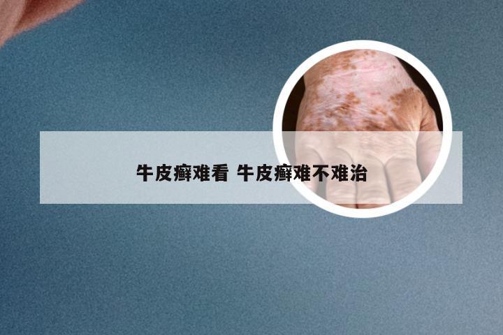 牛皮癣难看 牛皮癣难不难治