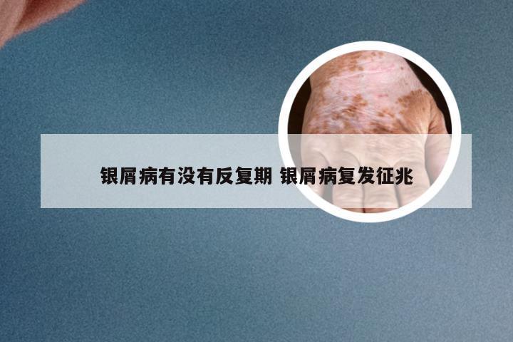 银屑病有没有反复期 银屑病复发征兆