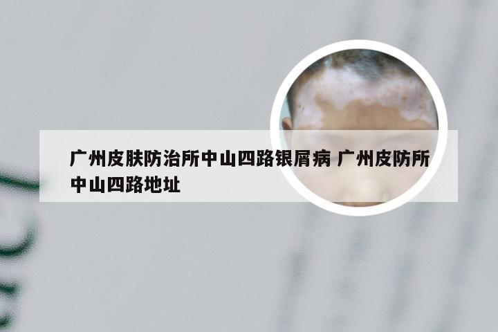 广州皮肤防治所中山四路银屑病 广州皮防所中山四路地址