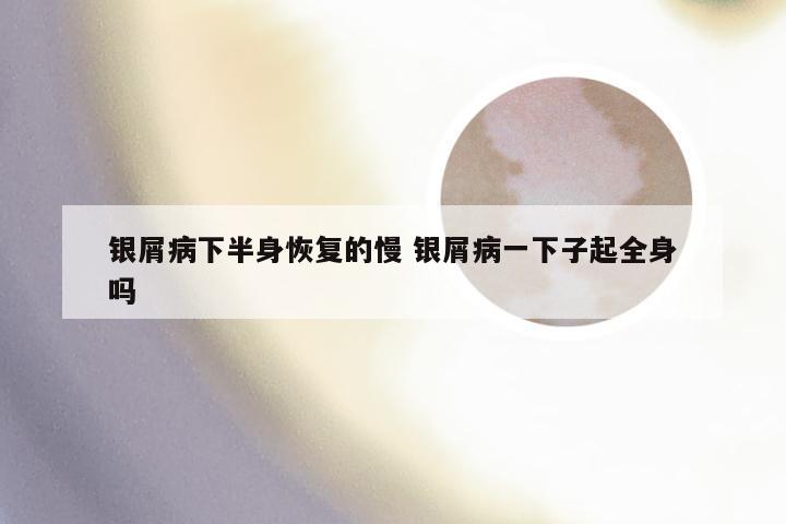 银屑病下半身恢复的慢 银屑病一下子起全身吗