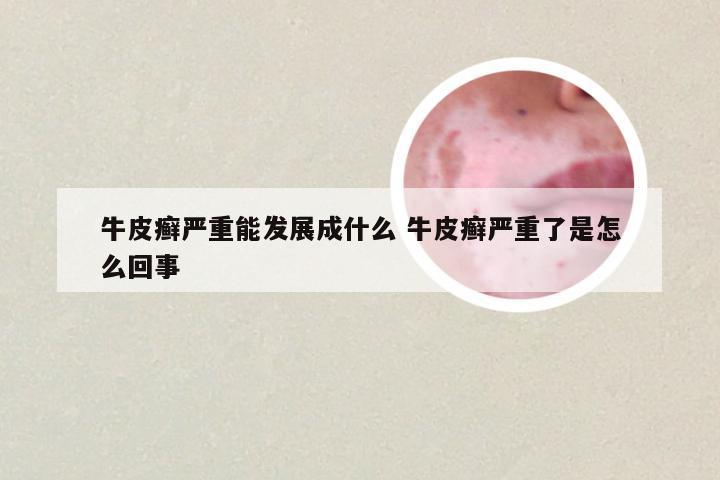 牛皮癣严重能发展成什么 牛皮癣严重了是怎么回事