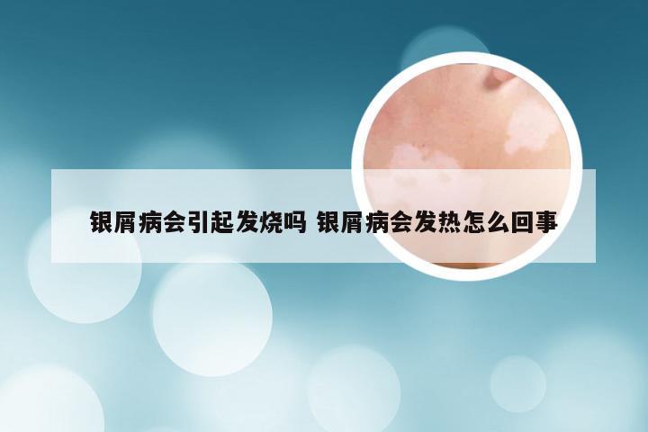 银屑病会引起发烧吗 银屑病会发热怎么回事