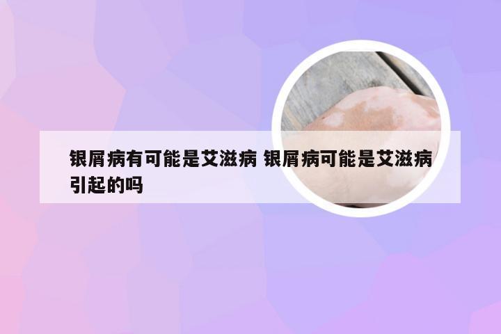 银屑病有可能是艾滋病 银屑病可能是艾滋病引起的吗