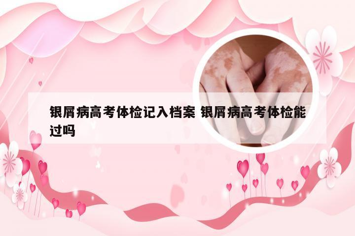 银屑病高考体检记入档案 银屑病高考体检能过吗